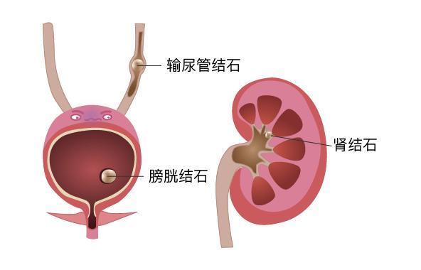 最新尿结晶研究动态，进展与临床应用探索