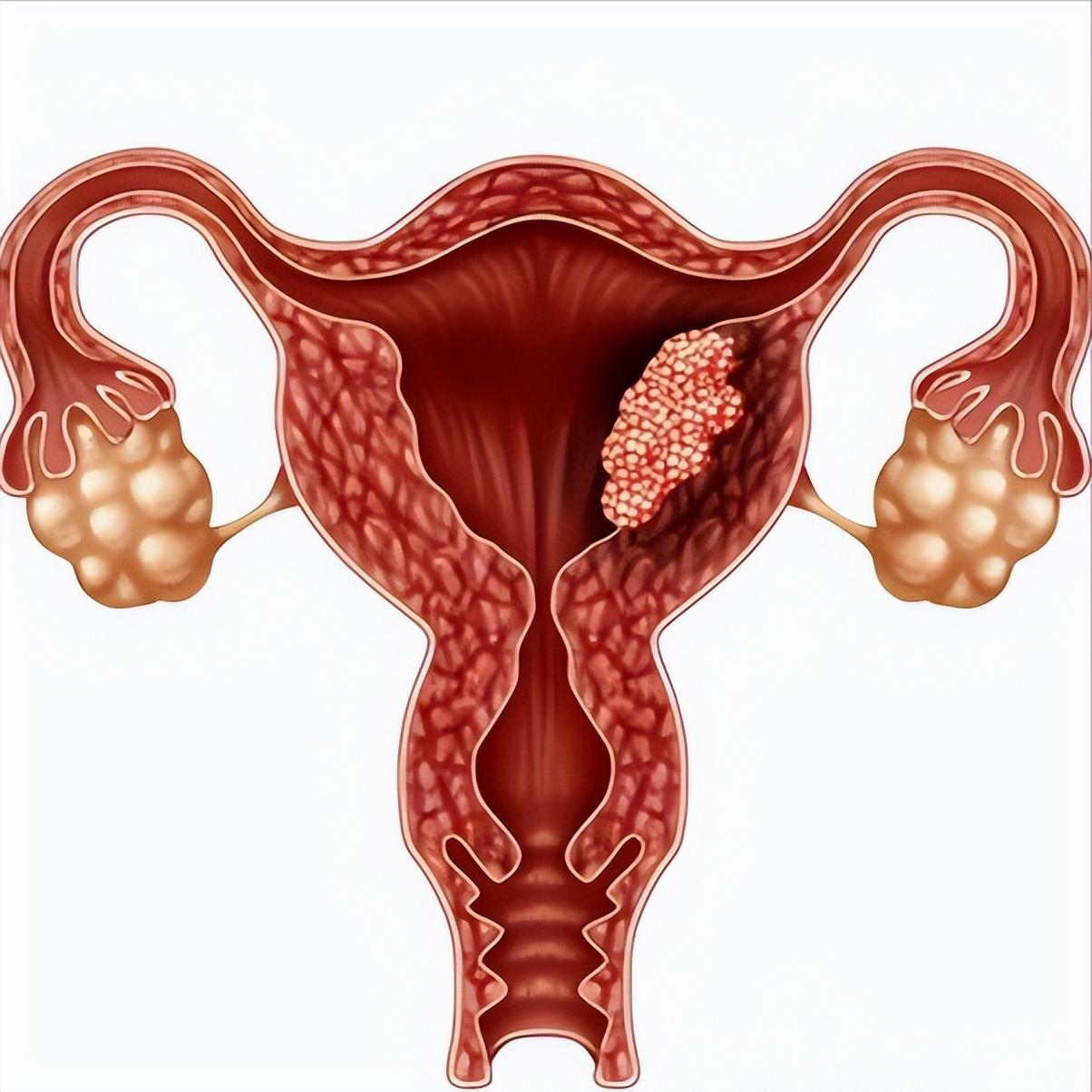 子宫腺肌症最新治疗方法探究与研究报告