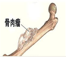 最新型骨癌，认识、诊断与应对策略