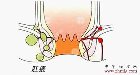 肛瘘的最新治疗方法概览